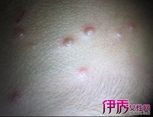 病毒性软疣的治疗
